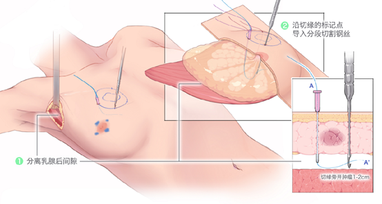 邵医微创直播｜乳腺癌不想切乳房，这项技术让她们少点缺憾