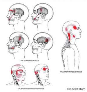 偏头痛怎么治疗-偏头痛是一种什么滋味听一听医生自己犯偏头痛是怎么处理的