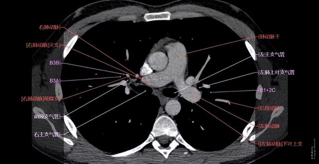 肺不好，CT看不懂21句口诀，轻松掌握肺部21个疾病的影像诊断