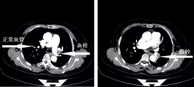 肺不好，CT看不懂21句口诀，轻松掌握肺部21个疾病的影像诊断