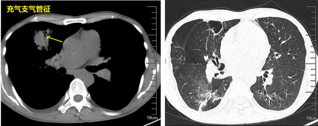 肺不好，CT看不懂21句口诀，轻松掌握肺部21个疾病的影像诊断