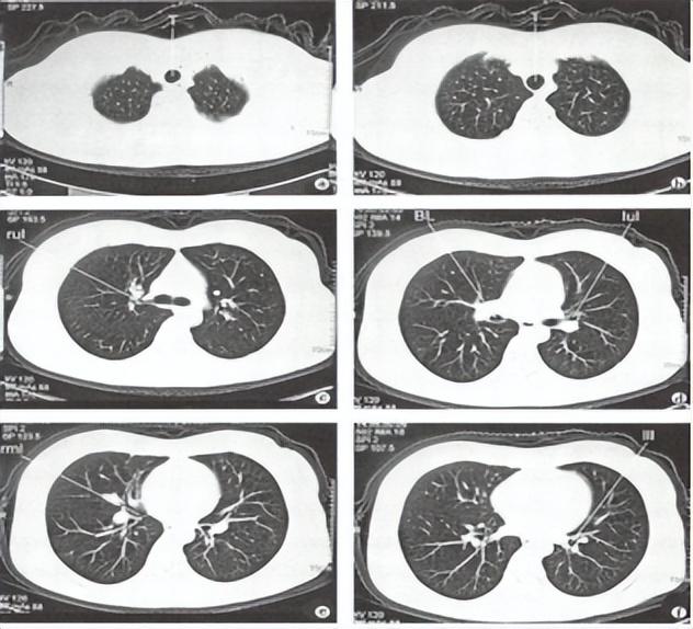 肺不好，CT看不懂21句口诀，轻松掌握肺部21个疾病的影像诊断