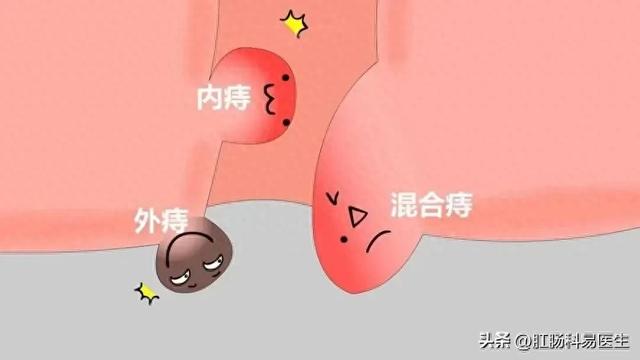 痔疮的术后护理怎么进行