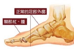 痛风性肾病的临床表现是什么痛风性肾病的治疗方法有哪些