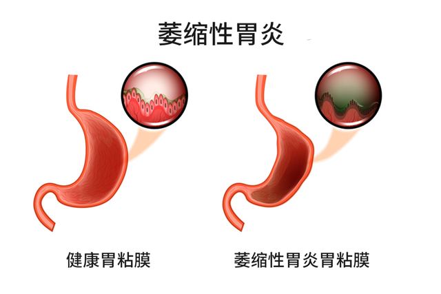 德国病理学之父：炎症是癌症的祸根，提醒：这5种炎症拖不得