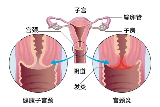 德国病理学之父：炎症是癌症的祸根，提醒：这5种炎症拖不得